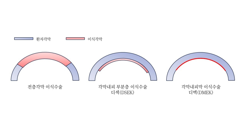 각막내피이식 수술 종류별 모식도./사진=서울성모병원