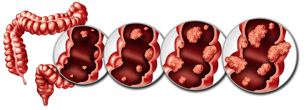대장암의 단계별 침범 과정.