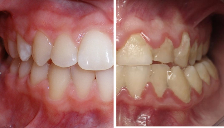 깨끗하고 건강한 입안(왼쪽)과 치태·플라그가 많이 쌓인 입안. /사진=관악서울대치과병원