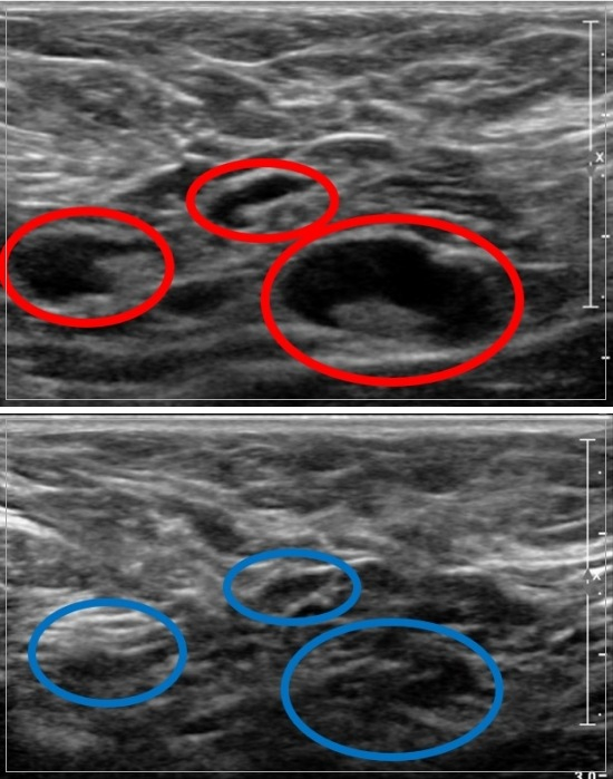 코로나19 백신을 맞은 직후 림프절병증이 발병한 모습(사진 위)과 시간이 지나 림프절병증이 사라진 초음파 사진./사진=한림대동탄성심병원