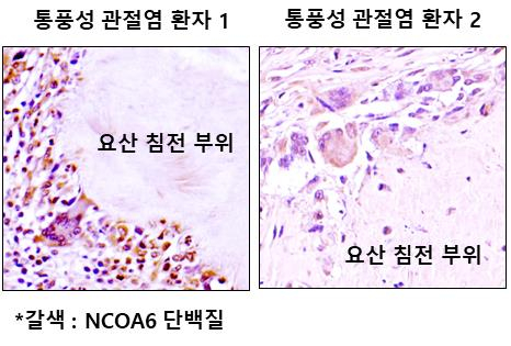 통풍성 관절염 환자의 병변부위에 핵수용체 활성보조인자 6(NCOA6)의 발현이 증가해 있다. 