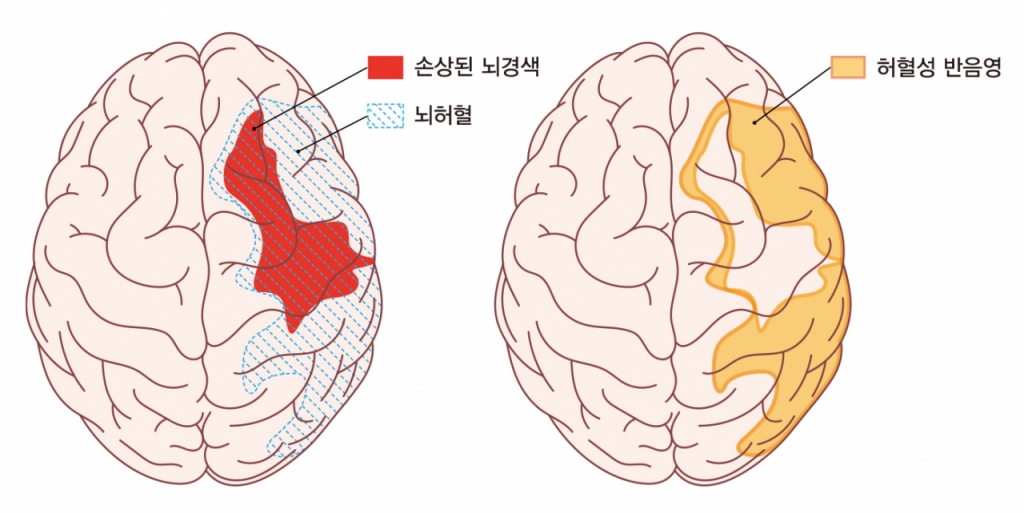 붉은색 부위는 손상된 뇌경색 중심부, 파란 빗금 부위는 뇌경색 중심부를 포함한 뇌허혈 부위, 노란색 부위는 급성기 치료의 중심 허혈성 반음영 부위다. /그림=강동경희대병원