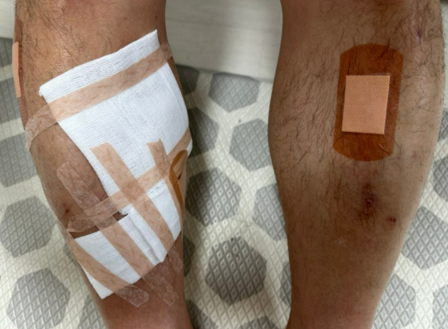 40대 직장인 A씨가 모낭염 치료를 받는 모습. /사진=독자제공