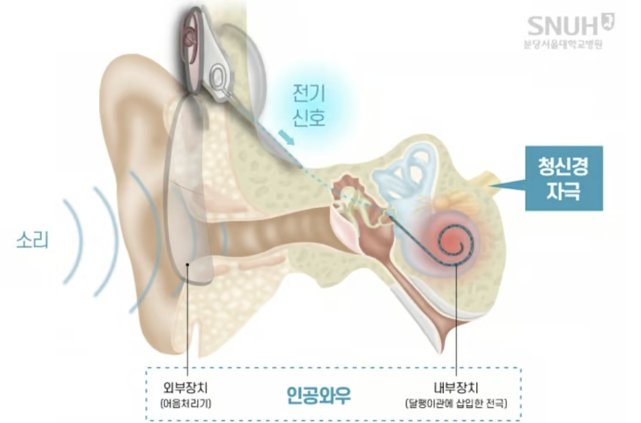 인공와우로 소리를 듣는 경로./사진=분당서울대병원