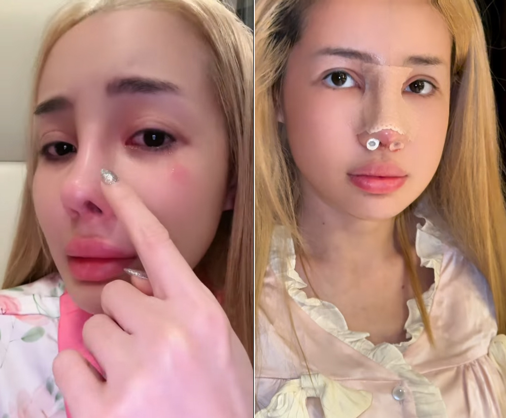 한국서 원정 코 성형→부작용에 눈물 쏟은 베트남 DJ 