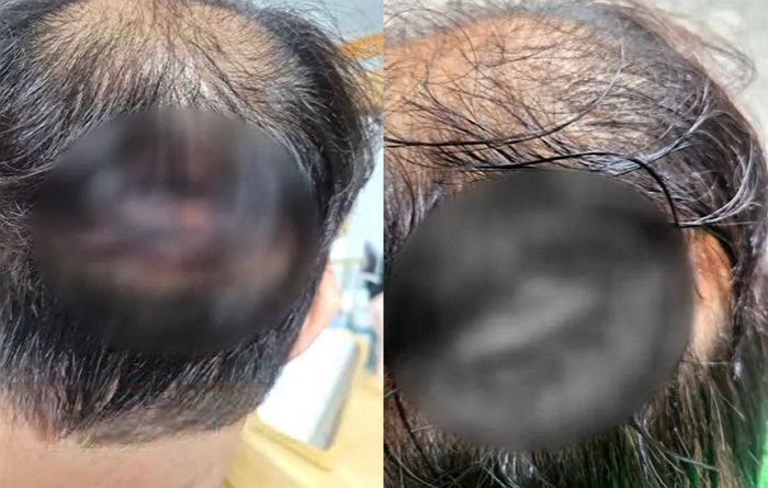 모발 이식술을 받은 남성이 두피가 괴사하는 등 부작용을 겪고 있다는 주장을 내놨다. /사진=JTBC '사건반장'