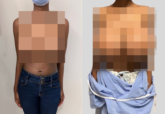 코로나19 백신을 접종한 뒤 유방비대증을 앓게 됐다는 여성의 사연이 전해졌다. /사진= PRS글로벌오픈 캡처