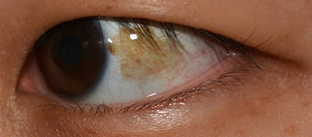 결막모반이 눈 흰자위를 덮고 있는 결막 상피층에 넓게 퍼진 모습./사진=김안과병원