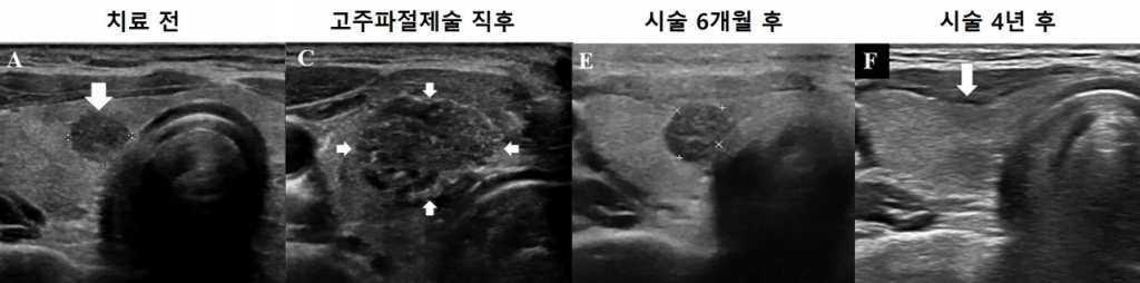 고주파절제술을 이용한 미세갑상선유두암 치료 과정. 시술 직후 괴사된 종양과 주변부가 넓게 보이지만 시간이 지나면 완전히 소멸됐다./사진=서울대병원
