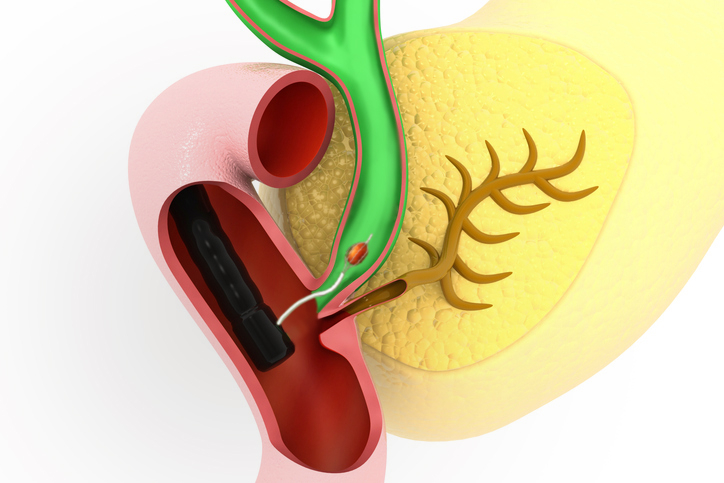 내시경적 역행성 담췌관조영술(ERCP)로 담관결석을 제거하는 과정을 설명하는 그림.
