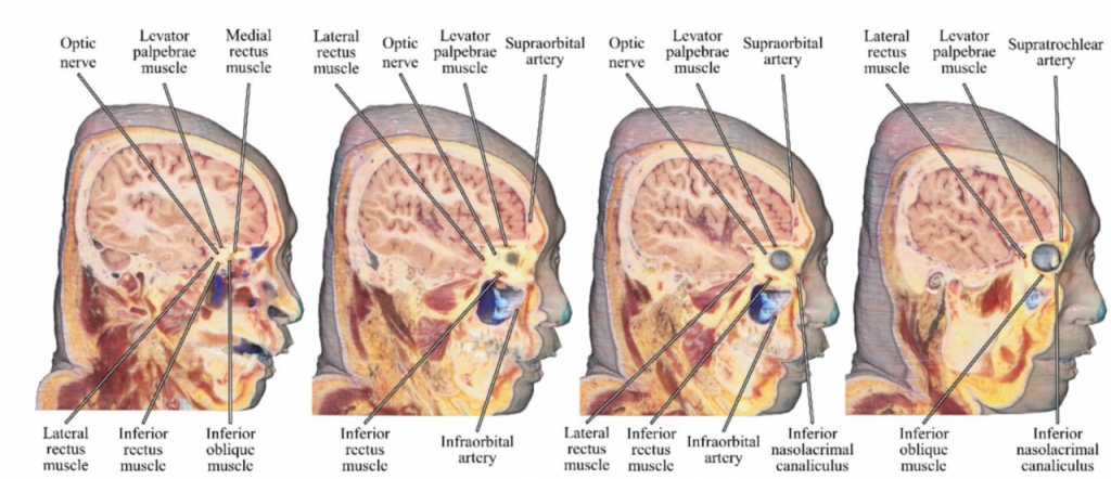 초고해상도 시신 절단면 영상 800여장을 활용해 구현한 3차원 눈동맥 주변 지도. 눈동맥.의 다양한 가지들과 주변을 지나는 뇌신경들의 위치를 정밀하게 확인할 수 있다./사진=연세대원주의과대학