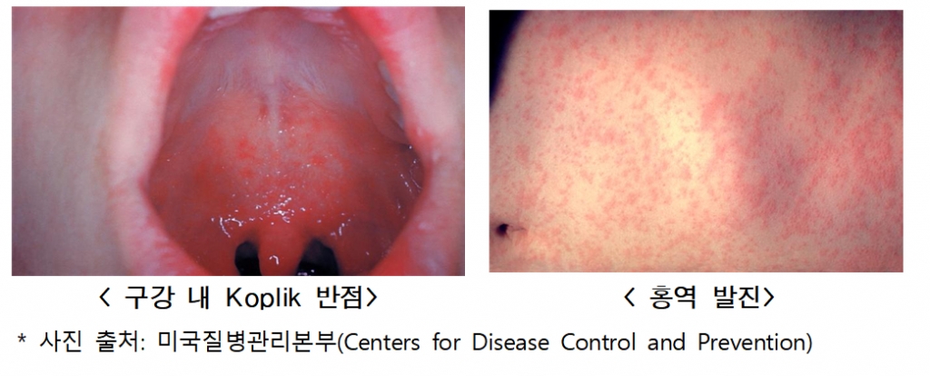 홍역 주요 증상./사진=미국질병관리본부,질병관리청