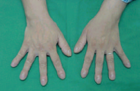 손가락 끝이 둥글게 되는 곤봉지 현상이 나타난 폐질환자의 손. /사진=대한내과학회