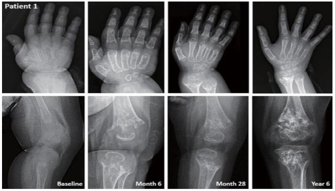 생후 10개월에 저인산효소증으로 진단받고 21개월차에 약물 치료를 시작한 저인산효소증 환자의 치료경과를 담은 엑스레이 사진. 치료를 진행할수록 뼈가 선명하게 관찰된다. /사진=조성윤 삼성서울병원 소아청소년과 교수 논문 발췌