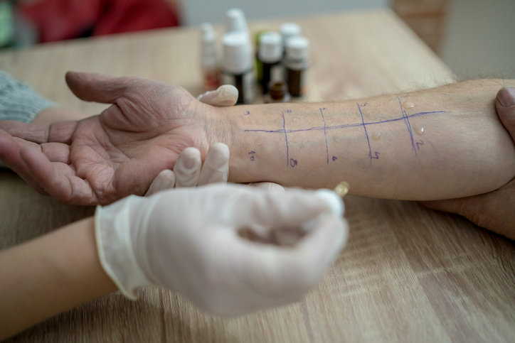 알레르기 유발 물질을 찾기 위한 피부 테스트. 