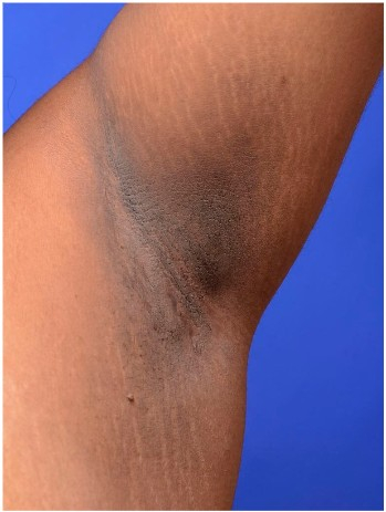 겨드랑이에 생긴 흑색가시세포증./사진=순천향대서울병원