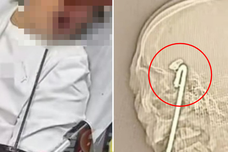 중국에서 한 남성이 술에 취해 넘어져 길이 약 40㎝ 쇠막대가 얼굴에 꽂히는 사건이 발생했다. 남성은 10시간 넘는 수술 끝에 기적적으로 생존했다. /사진=홍콩 사우스차이나모닝포스트(SCMP) 캡처