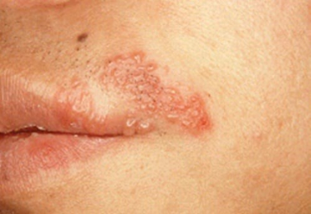 헤르페스 바이러스 감염 시 증상./사진=질병관리청 국가건강정보포털