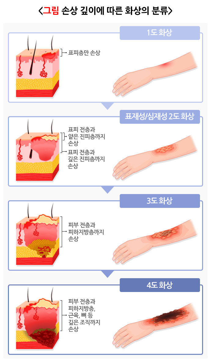 손상 깊이에 따른 화상의 분류. /자료=질병관리청 국가건강정보포털