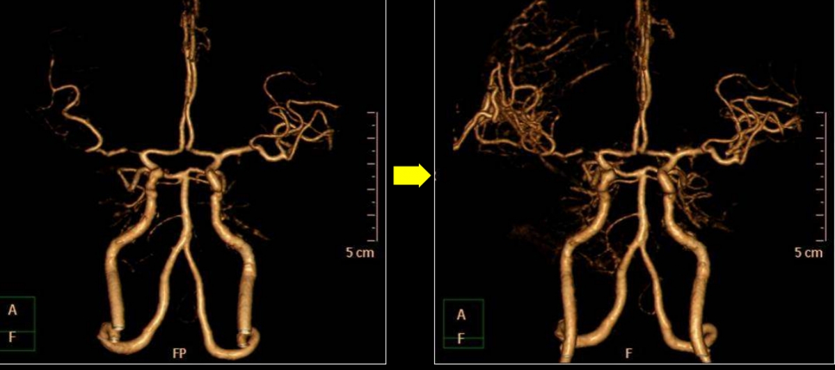 (사진 왼쪽부터) 막힌 뇌 혈관의 '우회로'를 뚫는 뇌혈관 문합술 전과 후 모습. /사진=에스포항병원