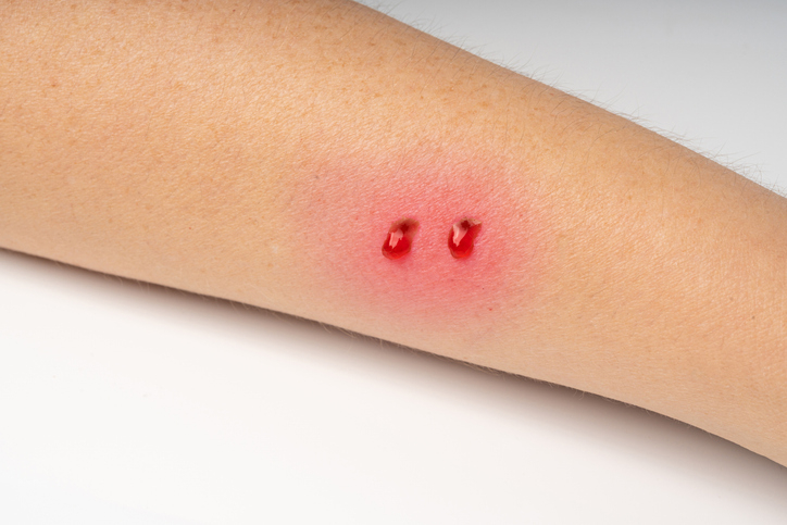 뱀 이빨에 사람 팔이 물린 자국.