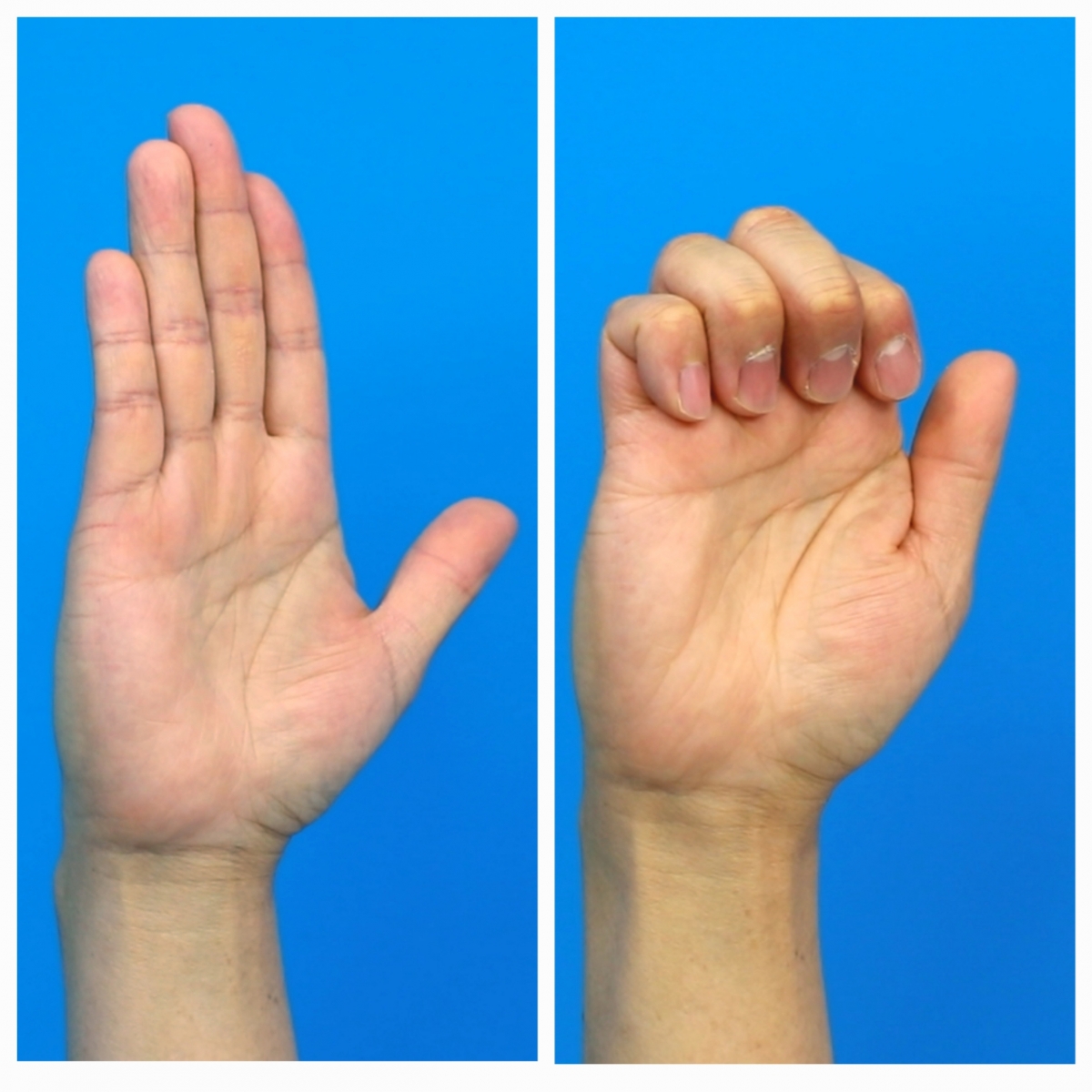 방아쇠 손가락 증상을 개선하는 데 도움 되는 '갈고리 주먹 운동'. 손가락 관절을 구부렸다 펴는 동작을 틈나는 대로 10~20회 반복. /사진=강동경희대병원 