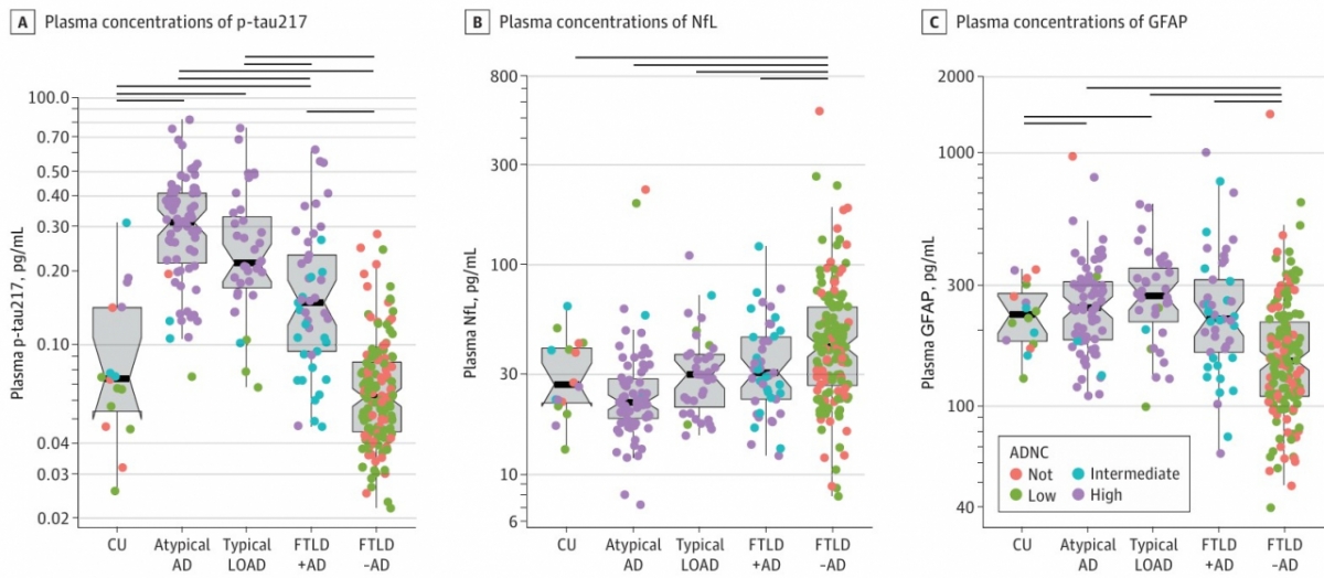 세 가지 바이오마커(p-tau217, NfL, GFAP)를 여러 치매 종류에 적용했을 때 비교 분석한 그래프. /자료=강남세브란스병원 