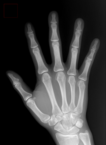 손 X선 사진./사진=바른세상병원