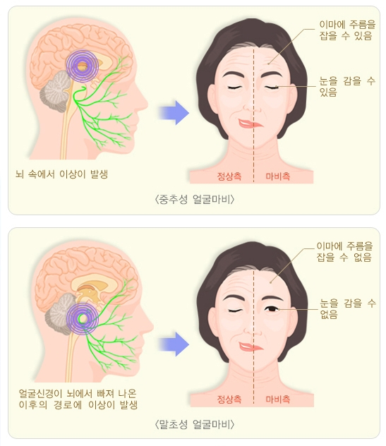 중추성 얼굴마비(위)와 말초성 얼굴마비(아래)의 특징적 증상. /자료=질병관리청 국가건강정보포털