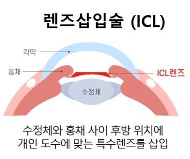 렌즈삽입술 과정./사진=온누리스마일안과  