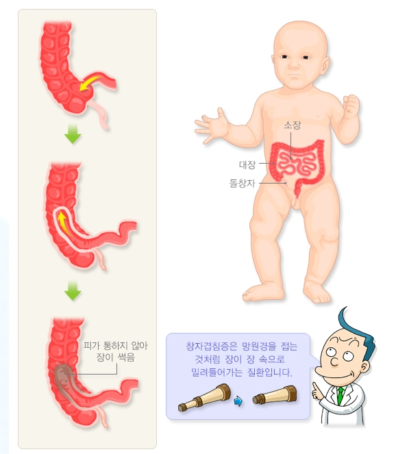 장중첩증이 생기는 과정. /자료=국가건강정보포털