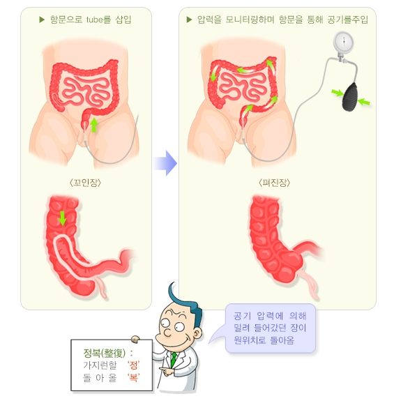장중첩증에 대한 정복술 시행 전후. /자료=국가건강정보포털