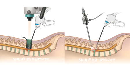 현미경 디스크 절제술(사진 왼쪽)과 양방향 내시경 디스크 절제술의 모식도. 현미경 디스크 절제술은 환부를 현미경으로 봐야하기에 양방향 내시경 디스크 절제술 보다 절개를 크게 해야 한다./사진=분당서울대병원