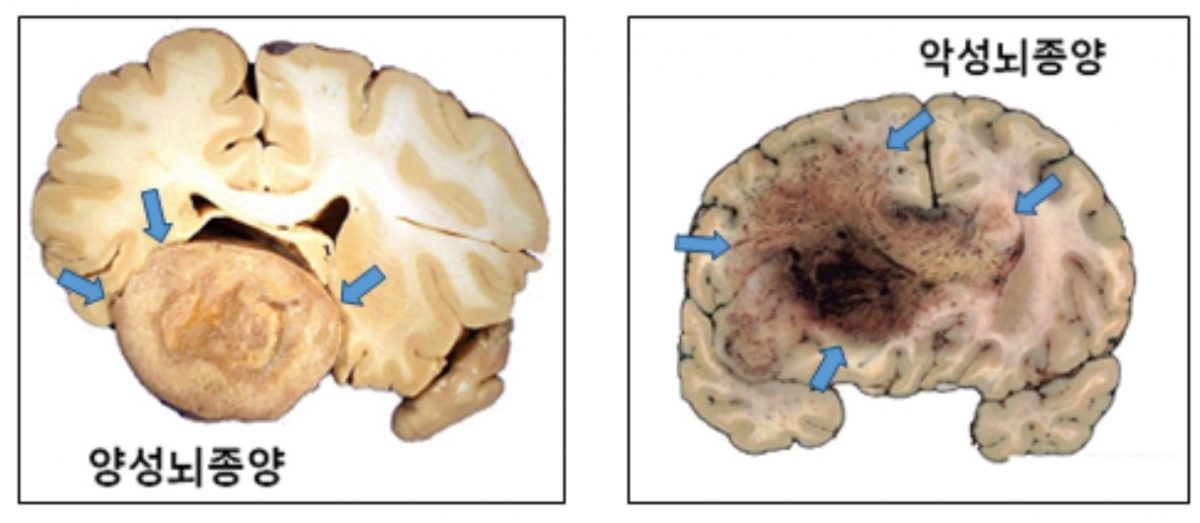양성 뇌종양(왼쪽)과 악성 뇌종양(오른쪽) 병변 비교. /사진=서울대병원 