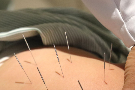  자생한방병원 의료진이 나랑체첵 씨의 등에 침치료를 실시하고 있다./사진= 자생한방병원 