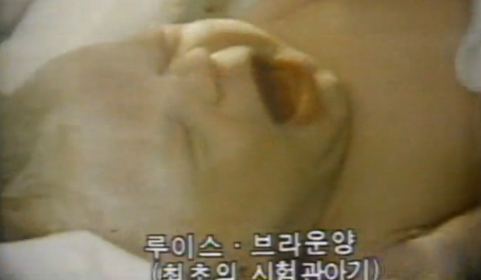 1978년 7월 25일 영국 올덤 종합병원에서 세계 최초의 '시험관 아기' 루이스 브라운이 태어났다. 출산은 비공개로 진행된 가운데, 사전 촬영된 일부 영상만 언론에 공개됐다. 불임 여성이 시험관 시술을 통해 임신해 출산한 것임을 입증하기 위해 제왕절개 수술 장면과 산모의 나팔관 이상을 보여주는 장면이 담겼다. /사진=MBC 뉴스 방송 화면