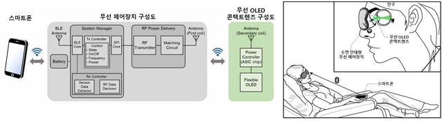 무선 OLED 콘택트렌즈를 활용한 망막전위도 검사 시스템의 모식도와 실제 검사 모습의 예시. /사진제공=분당서울대병원