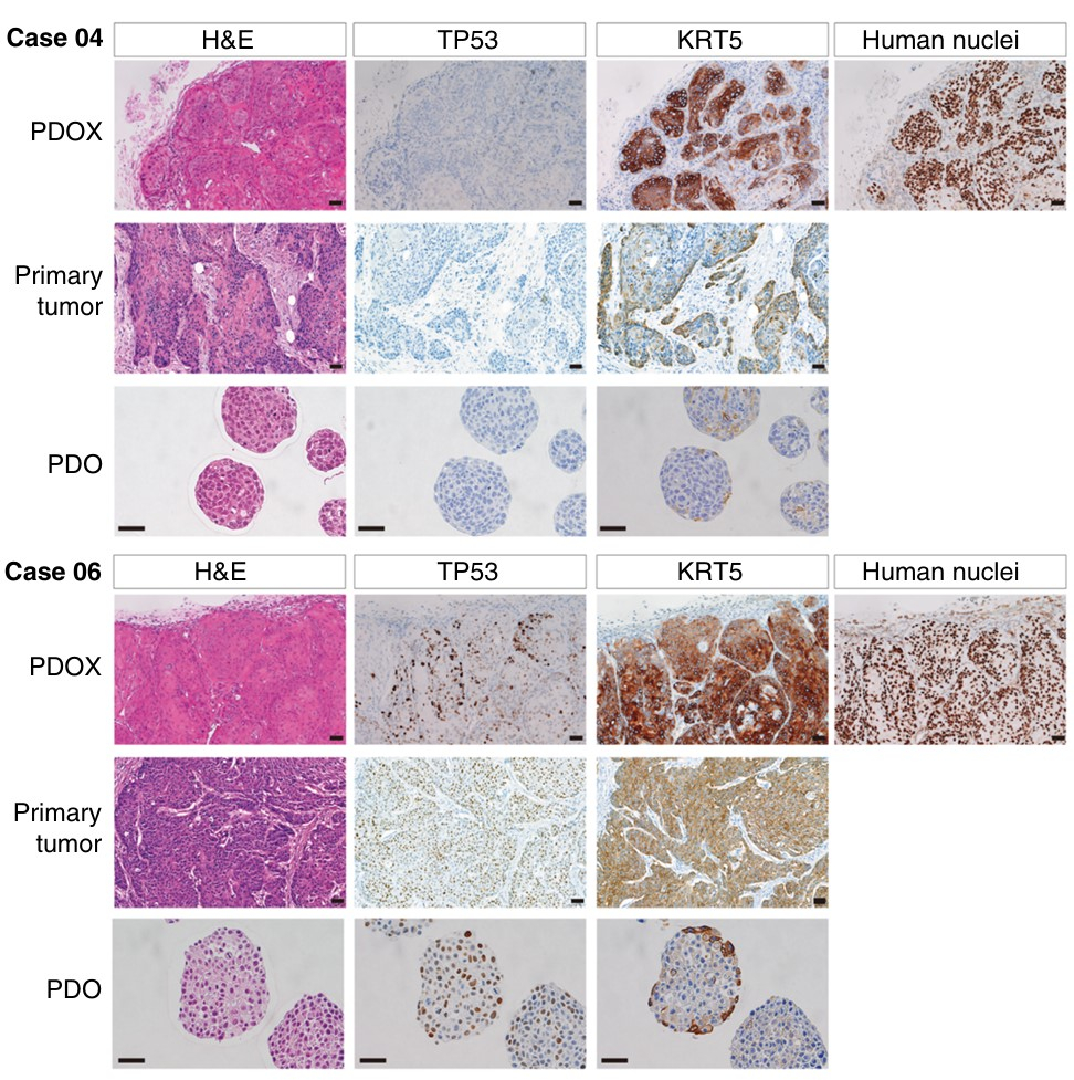 연구팀이 다양한 유전자 돌연변이를 동반한 두경부암 오가노이드 배양에 성공했음을 보여주는 두경부암 오가노이드 라이브러리. /사진제공=강남세브란스병원