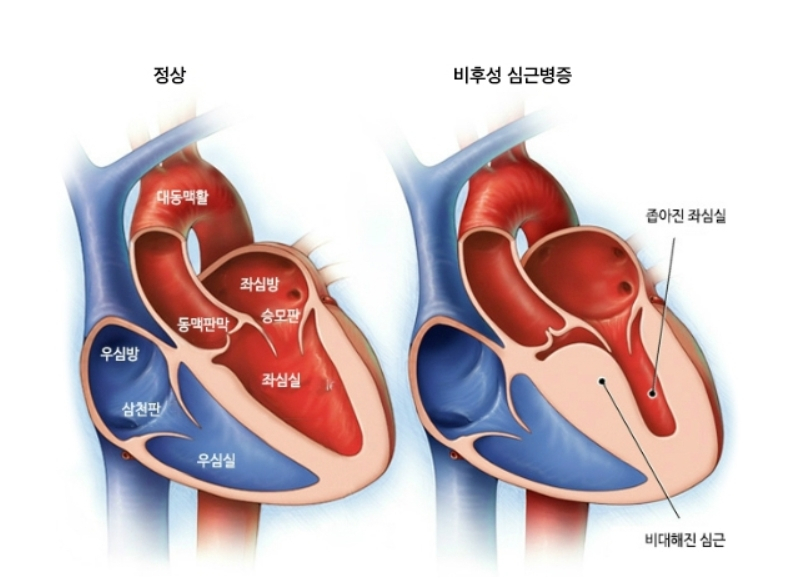 건강한 심장(왼쪽)과 근육이 두꺼워진 비후성 심근병증 심장(오른쪽). /그림=서울아산병원