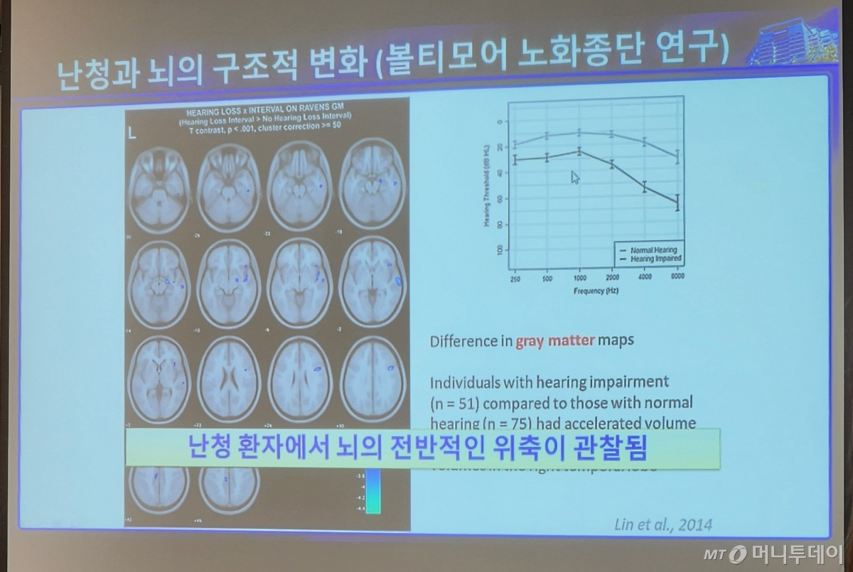 9일 대한이과학회가 난청 환자에게 뇌의 전반적인 위축이 관찰된 병변을 설명한 발표 자료. /사진=정심교 기자