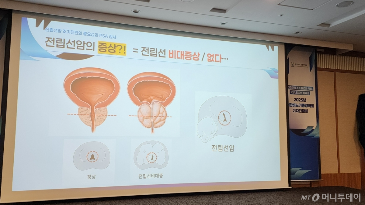 이날 학회에 따르면 전립선암 환자에겐 전립선 비대증의 증상이 있을수도, 없을수도 있다. 따라서 전립선 비대증 유무만으로는 전립선암을 알아채기가 어려워 국가암검진 항목에 PSA 검사가 포함돼야 한다는 게 학회의 제언이다. /사진=정심교 기자 