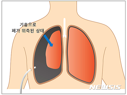 폐 기흉 참고 이미지. 기사와 직접적 관련 없음. /사진=뉴시스