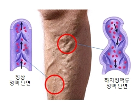 하지정맥류는 혈류 흐름을 방해해 전신 피로감을 유발할 수 있다. /사진=서울아산병원 건강정보