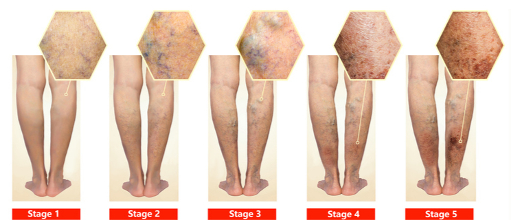 하지정맥류의 진행 과정.