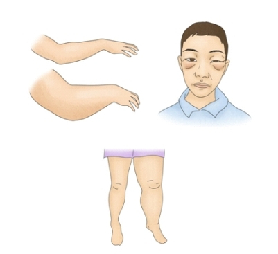 만성 신부전 환자에게 나타나는 부종 병변. /그림=서울아산병원 건강정보