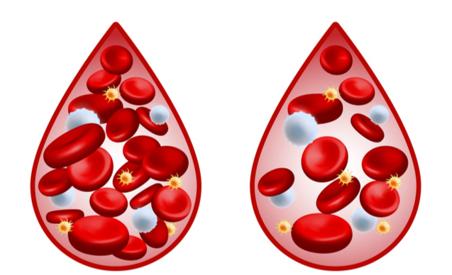 정상 피(왼쪽)와 빈혈(오른쪽)의 혈색소(헤모글로빈) 농도와 적혈구 양을 비교한 그림.