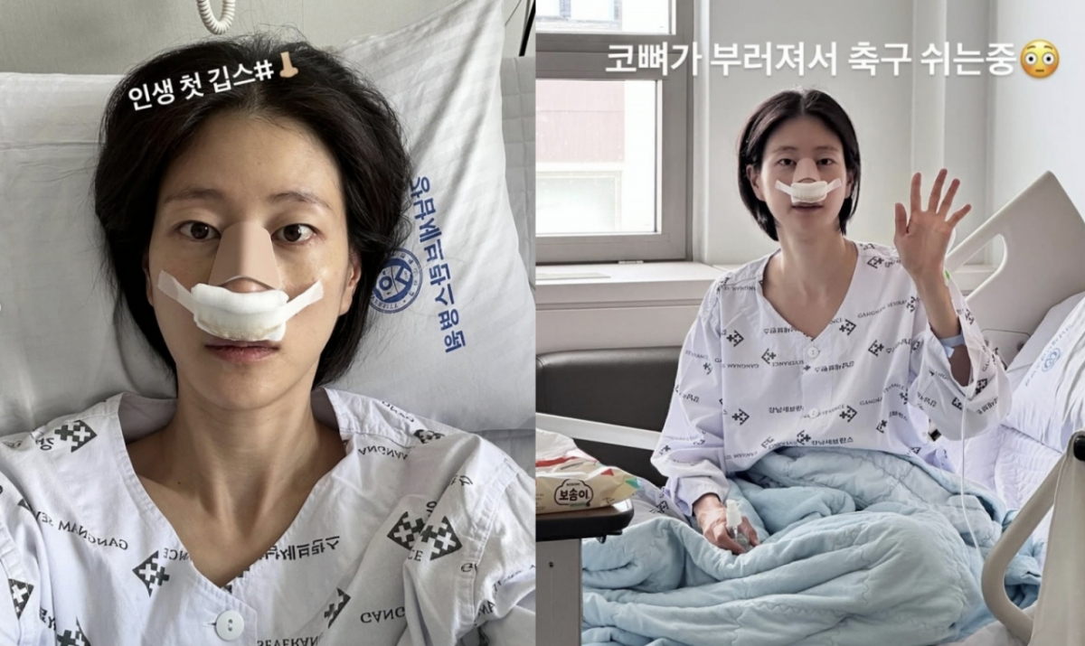 방송인 이현이가 축구 경기 중 코뼈가 골절되는 부상을 입었다./사진=이현이 SNS