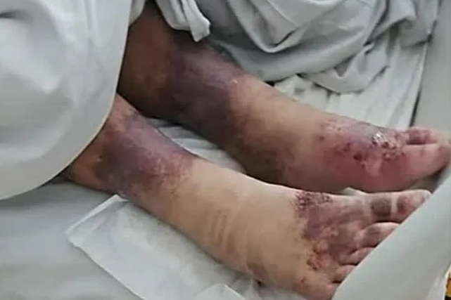 27년 전 실종된 줄로 알았던 폴란드 여성 미렐라(42)가 부모에 의해 감금됐던 것으로 드러났다. 구조 당시 미렐라는 다리 부위에 심한 상처를 가지고 있었다. /사진=영국 더선 캡처 