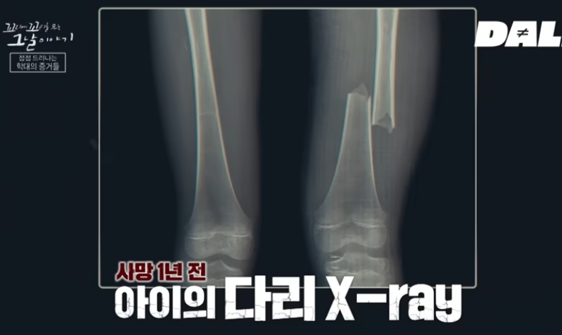 계모 폭행으로 이양 허벅지 뼈가 부러졌을 당시 X-ray 사진. /사진=유튜브 채널 달리 갈무리