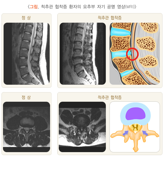 척추관협착증 환자의 요추부 자기공명영상(MRI) 이미지. /사진제공=질병관리청